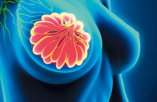 radiotherapie-auxilliaire-cancer-sein