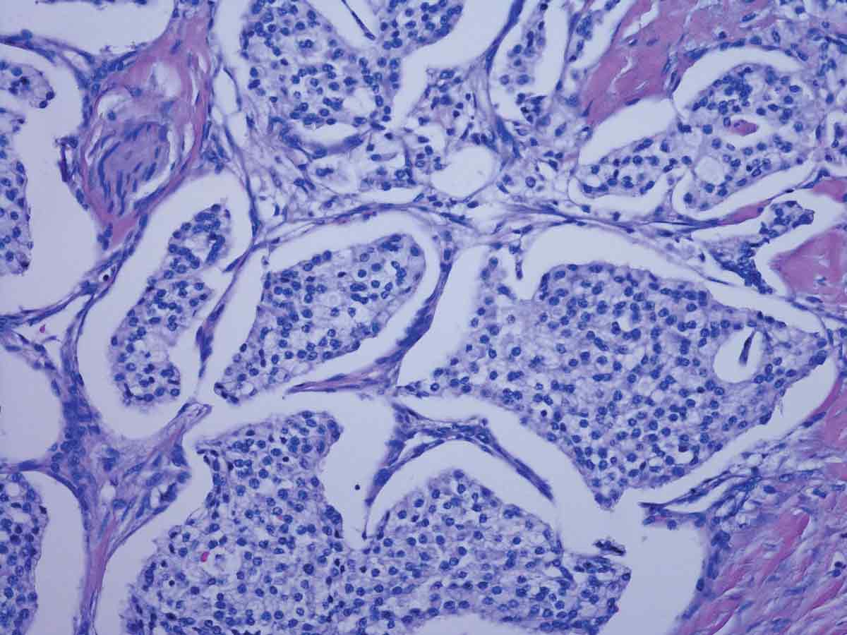Acheter Tumeurs neuroendocrines digestives Tumeurs neuroendocrines digestives